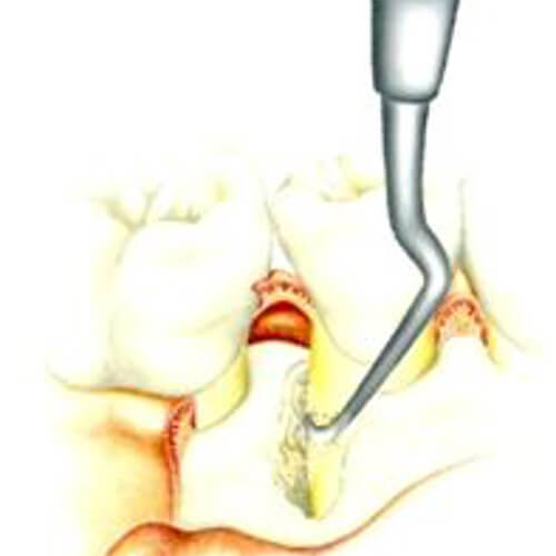 歯周病再生療法