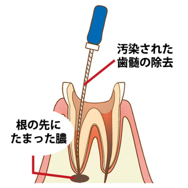 根管清掃