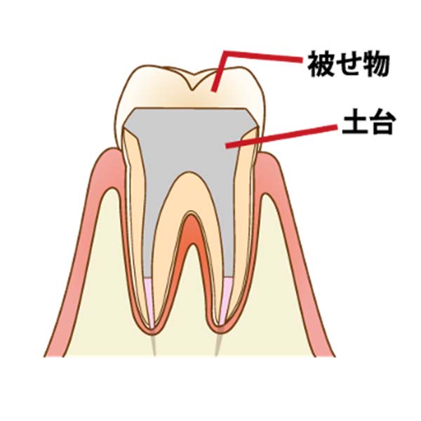 土台を立ててかぶせものをします